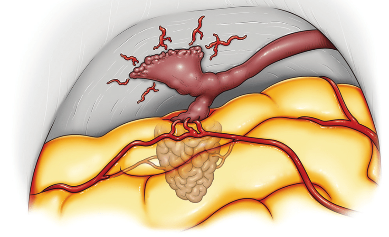 Neurovascular Invasive Care